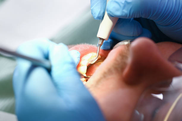 Best Emergency Tooth Extraction in Decatur, TX